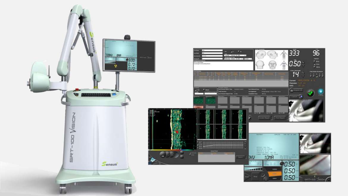 SRT-100-Vision Superficial Radiation Therapy (SRT)