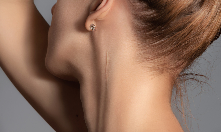 Woman with surgery scar at her neck. Scar Revision in Pflugerville, TX