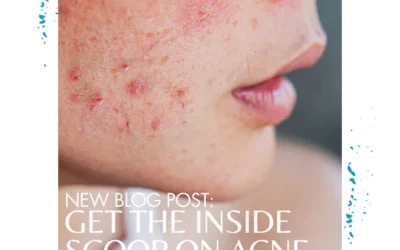 Get the Inside Scoop on the Types of Acne and How to Deal with Them!