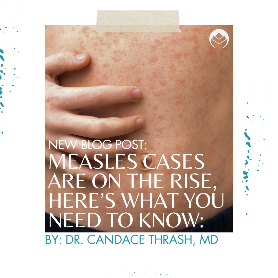 Measles Cases Are on the Rise, Here’s What You Need to Know: